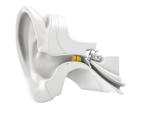 Lyric Hearing Aids